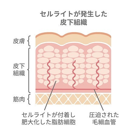 高周波による脂肪分解！